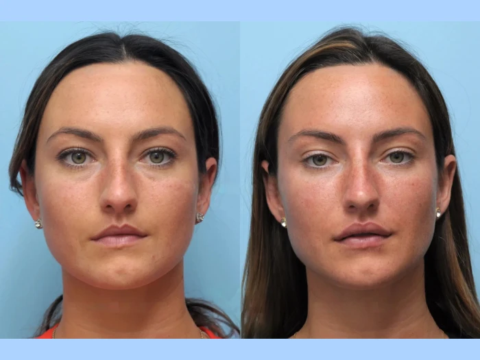 Expert Care and Lasting Results from the Best Plastic Surgeons in Dubai for Thread Lift